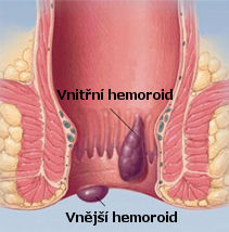 Hemoroidy, někdy nazývané též hemeroidy
